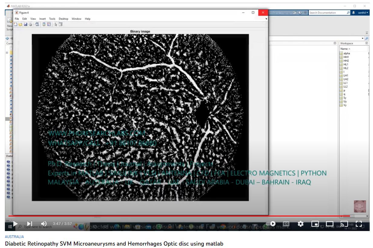 Diabetic_Retinopathy_Svm Microaneurysms Hemorrhages Optic Disc Using Matlab - project simulation thumbnail for Signal Processing and AI Engineering