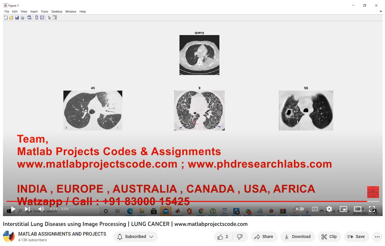Interstitial Lung Diseases Using Image Processing _ Lung Cancer project simulation thumbnail for Signal Processing and AI Engineering